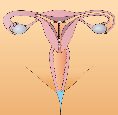 How an IUD works