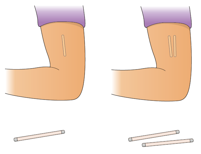 How an implant works